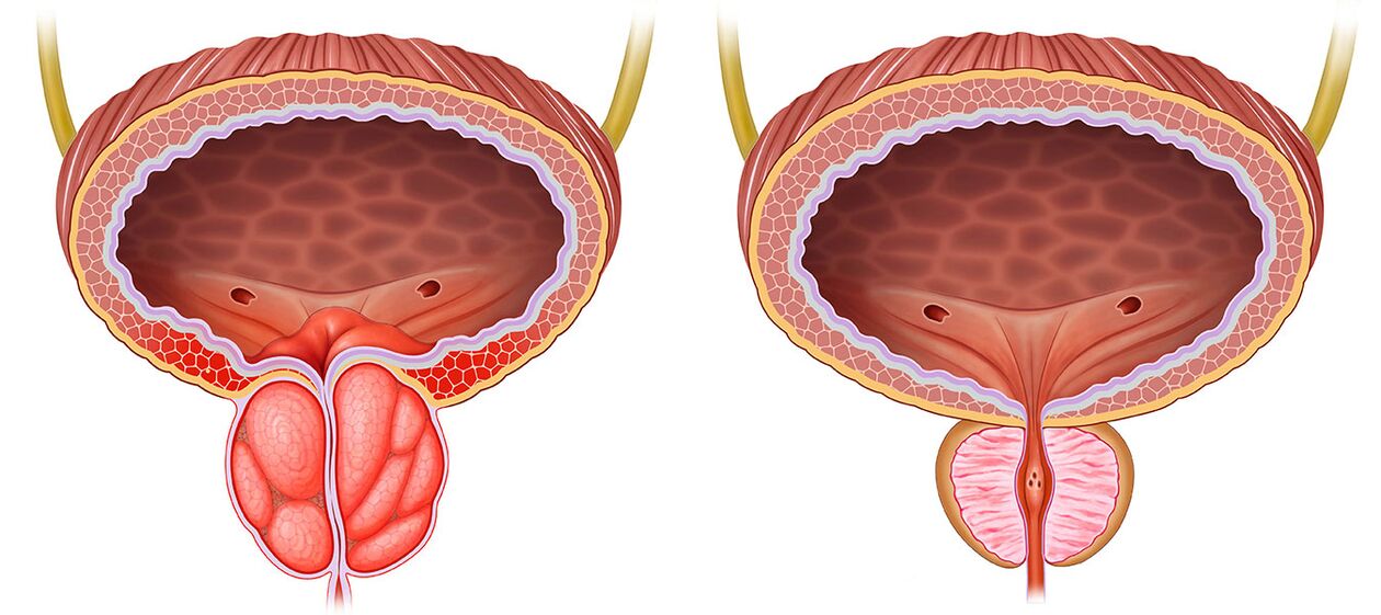inflamed and healthy prostate after using Predstonorm capsules